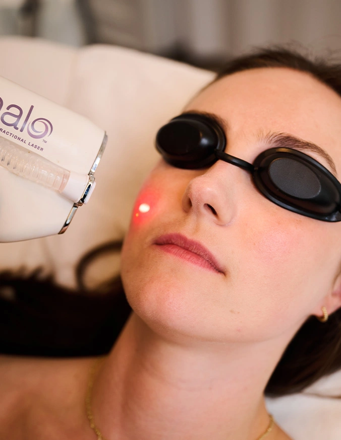 Woman Halo laser treatment with protective goggles and handheld device on face - Halo laser treatment in Alpharetta, GA