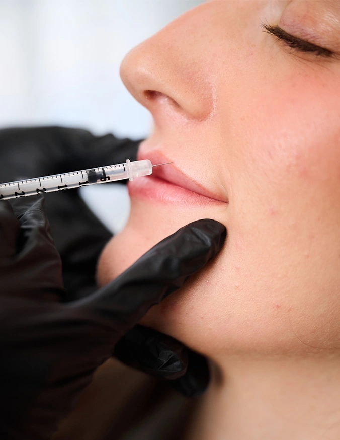 Medical professional administering lip filler injection with syringe to patient's lips during cosmetic procedure - Lip fillers in Alpharetta, GA