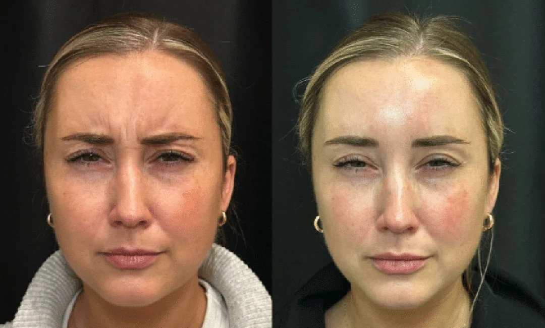 botox-dysport-1
