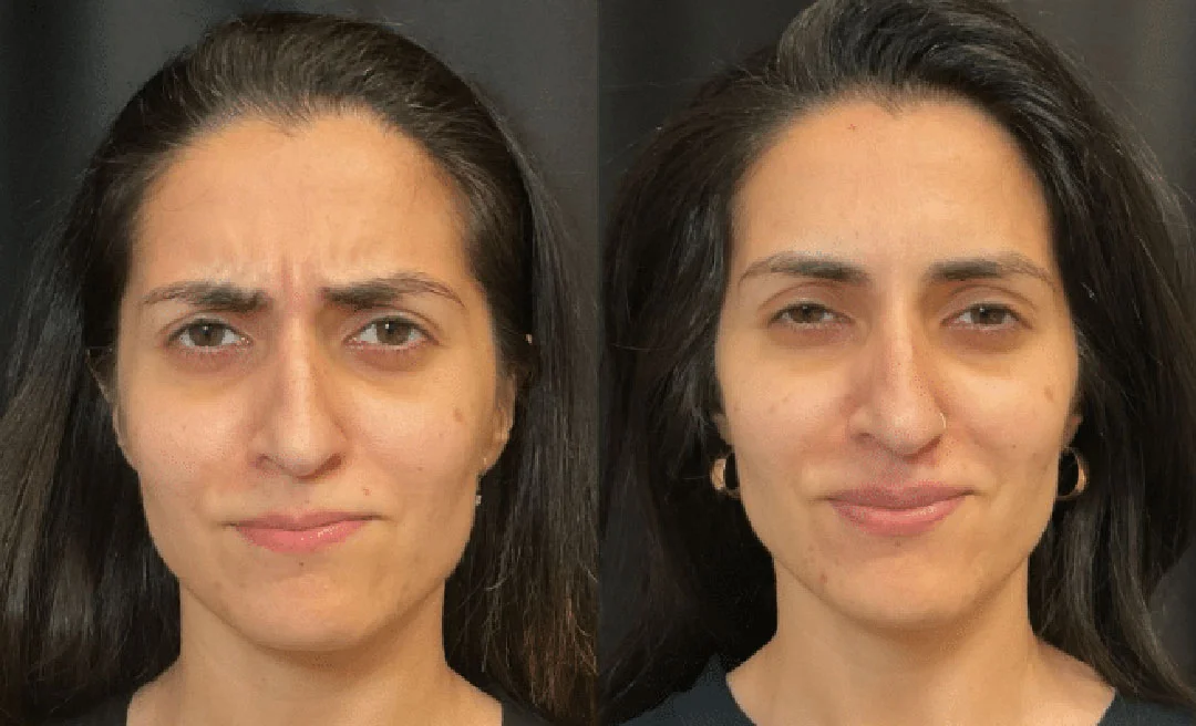 botox-dysport-10