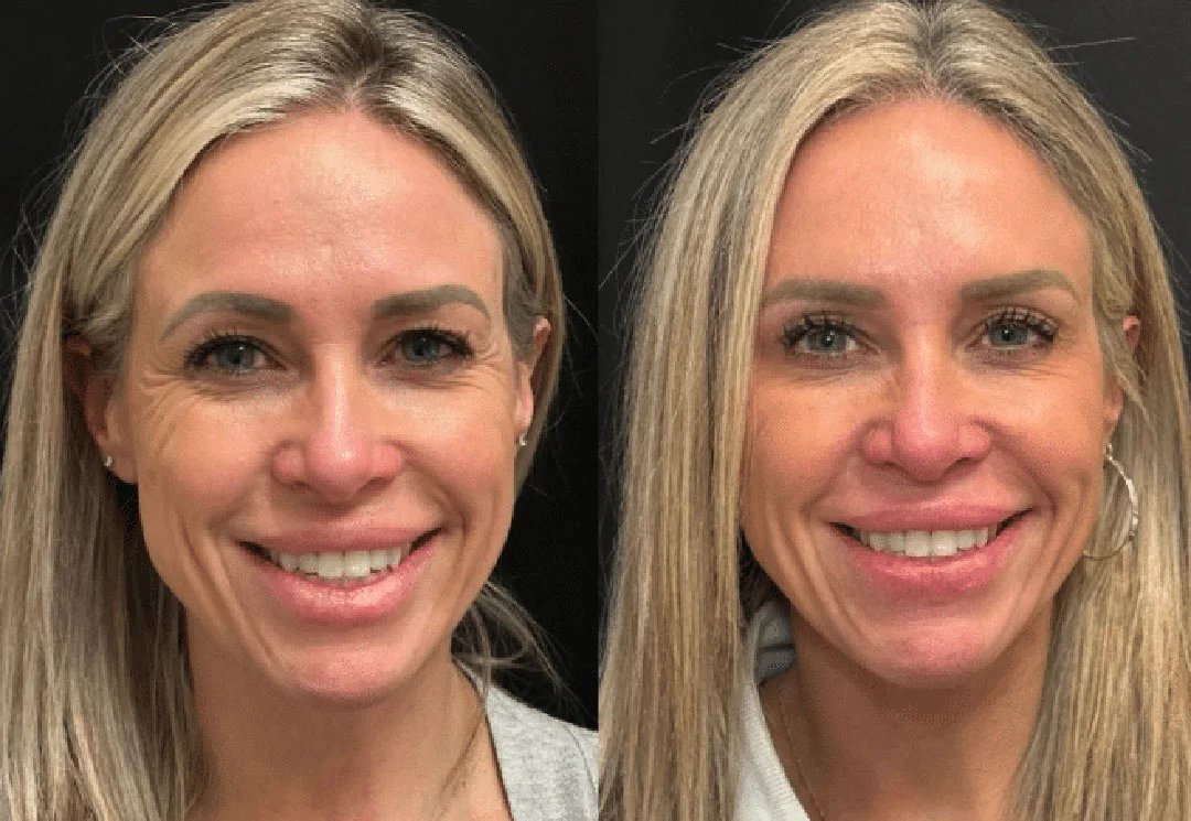 botox-dysport-11