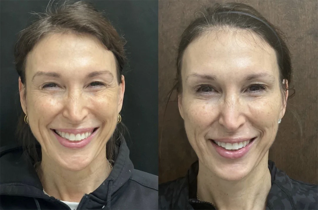 botox-dysport-12