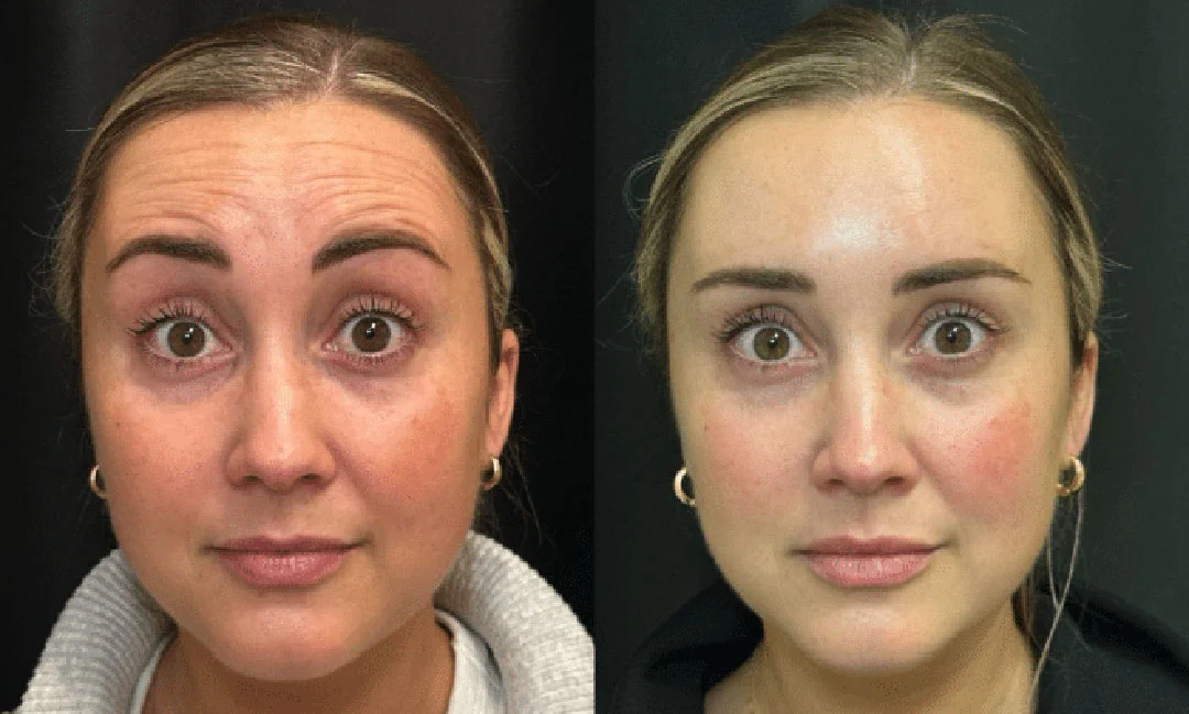 botox-dysport-2