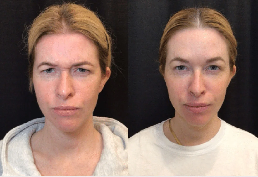 botox-dysport-3