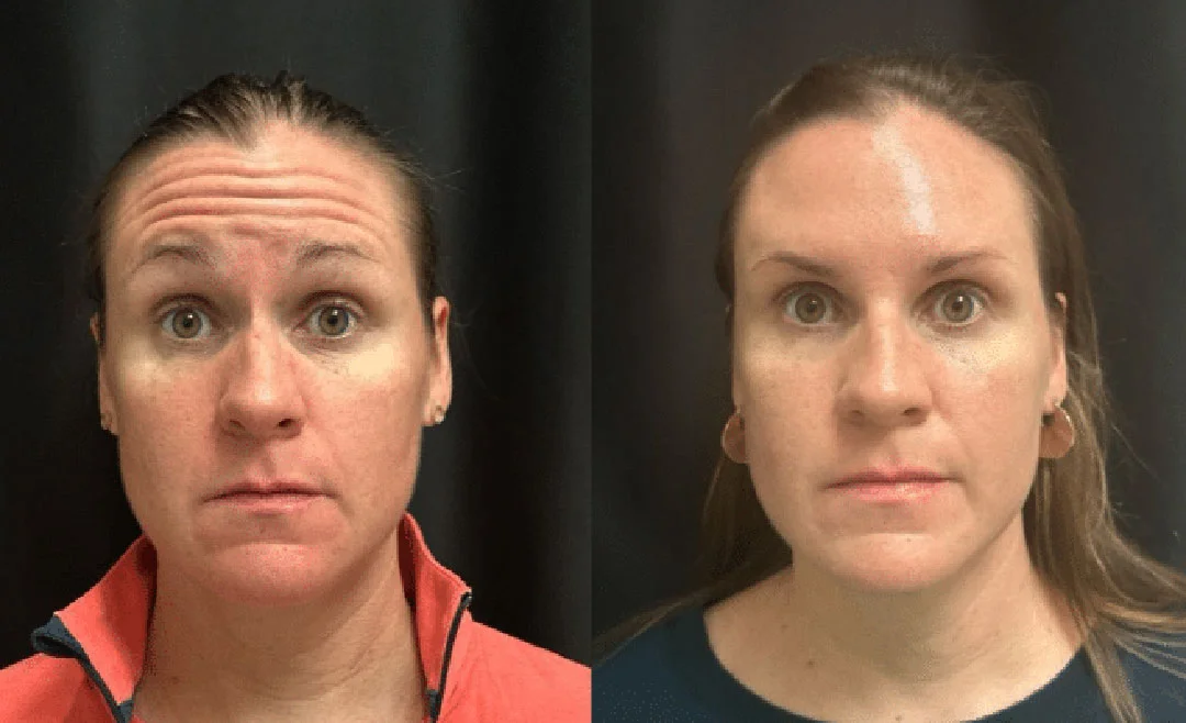 botox-dysport-4
