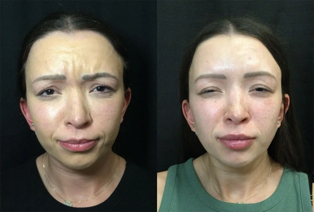 botox-dysport-5