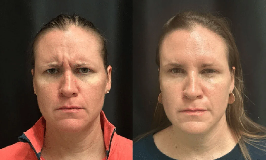 botox-dysport-6