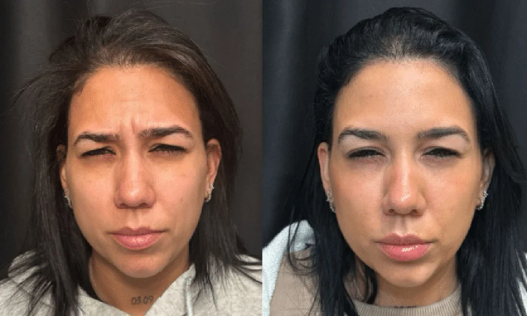 botox-dysport-7