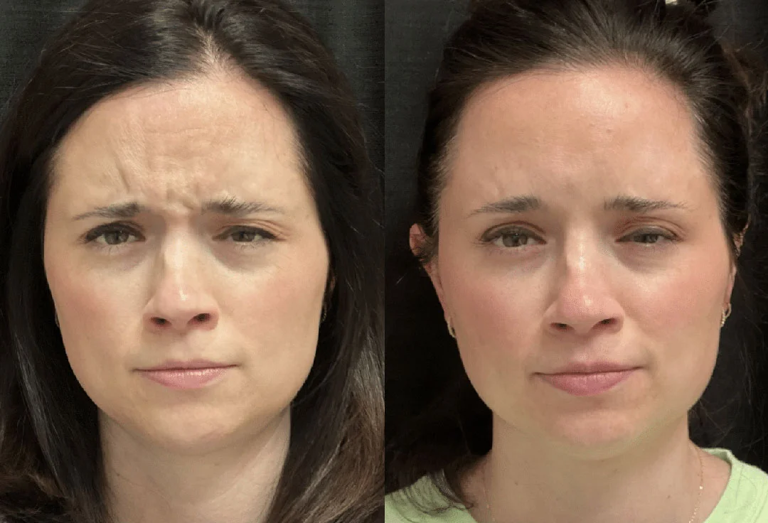 botox-dysport-8