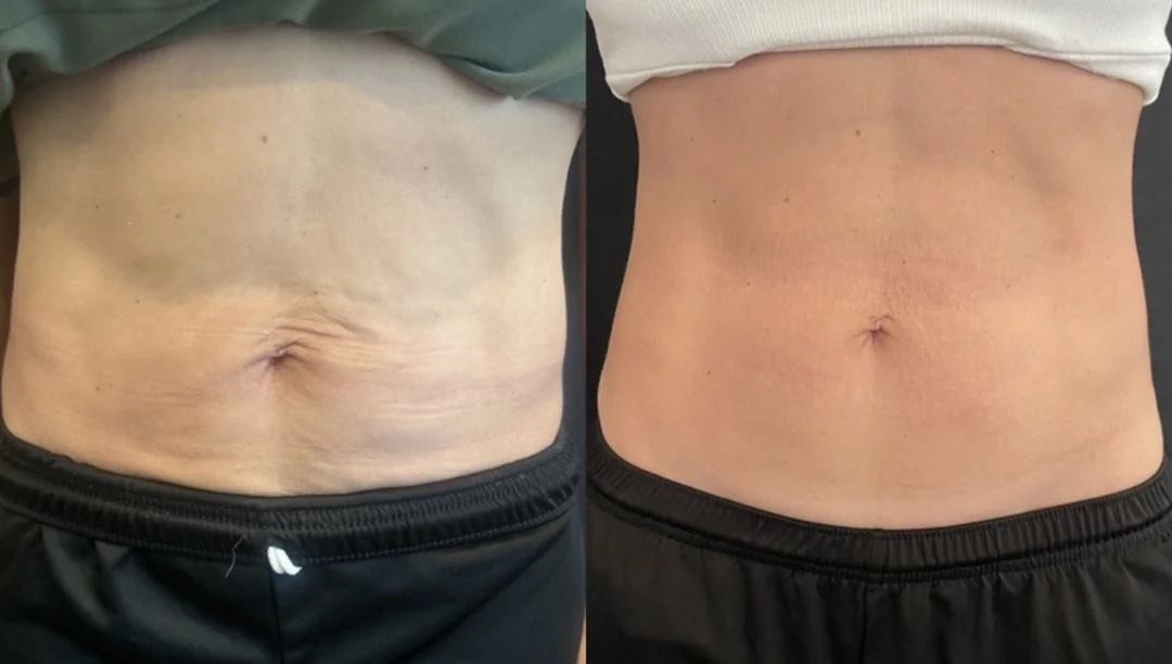 coolsculpting-1