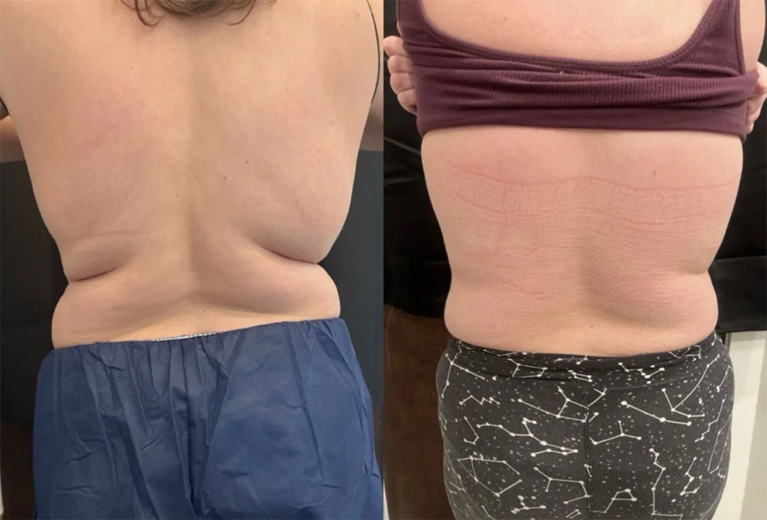 coolsculpting-2