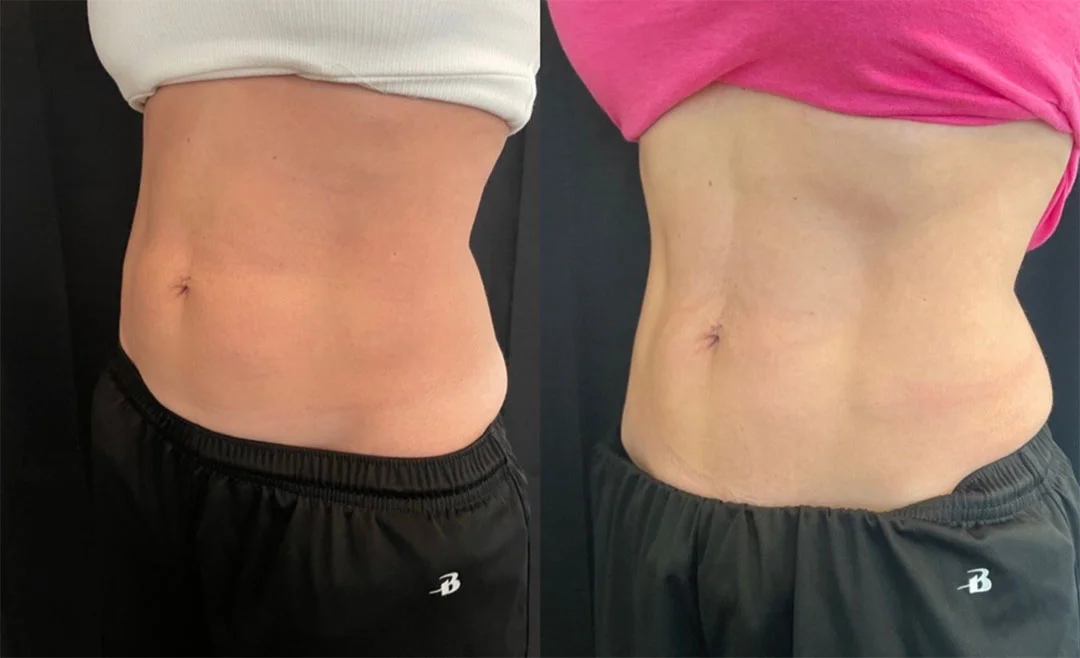 coolsculpting-3