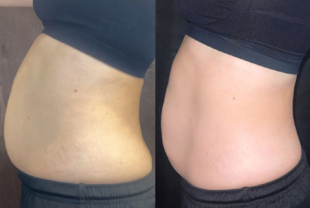 coolsculpting-4