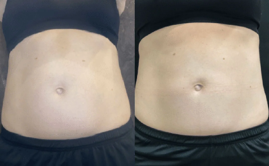 coolsculpting-5