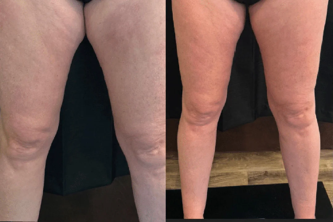 coolsculpting-6
