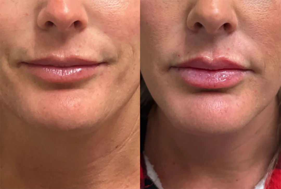 lip-filler-11
