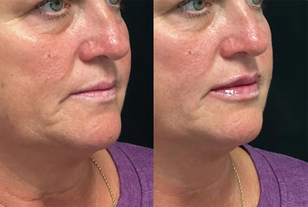 lip-filler-12