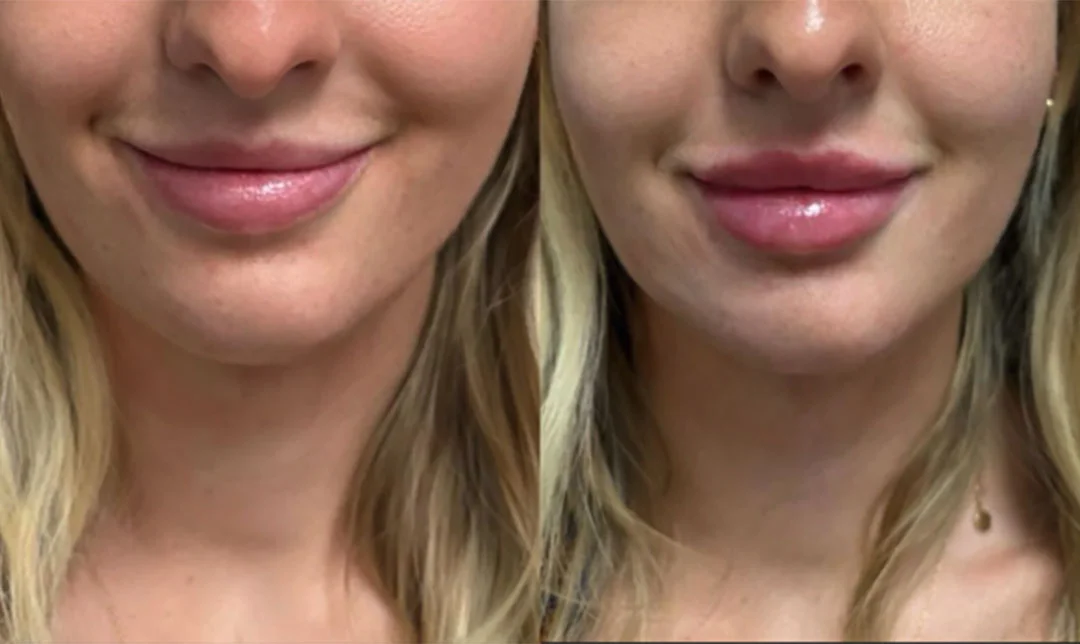 lip-filler-13