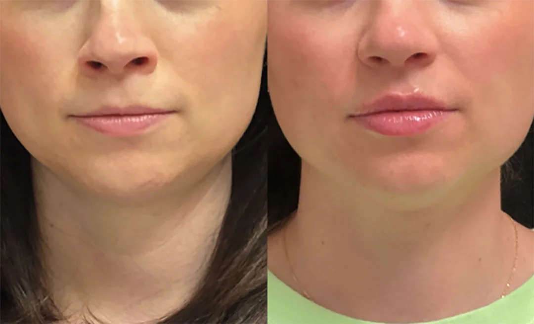 lip-filler-15