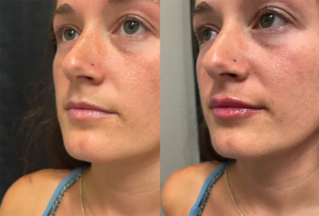 lip-filler-16