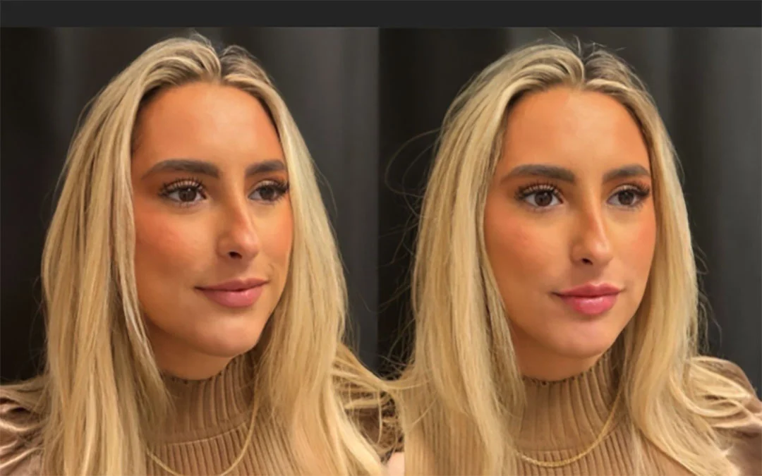 lip-filler-17