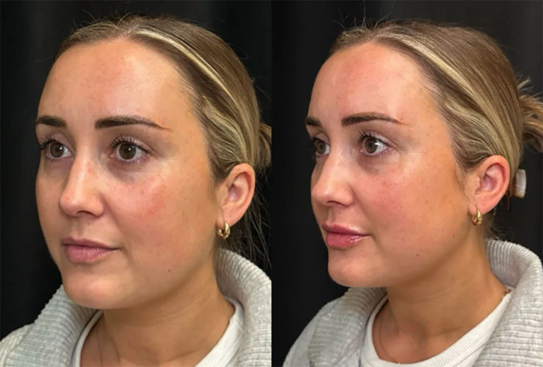 lip-filler-18