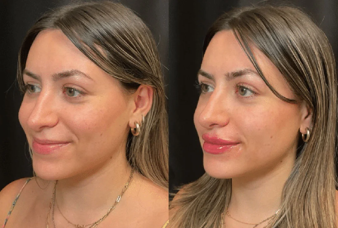 lip-filler-2
