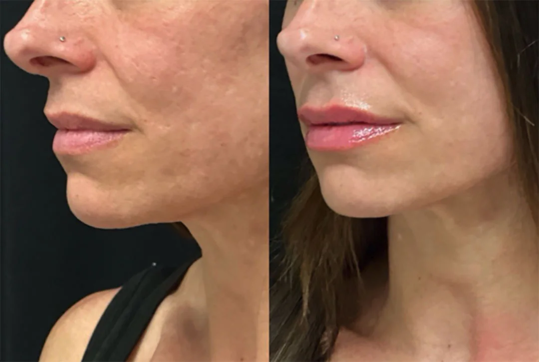lip-filler-20