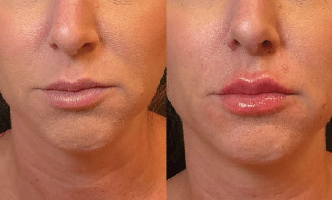 lip-filler-3