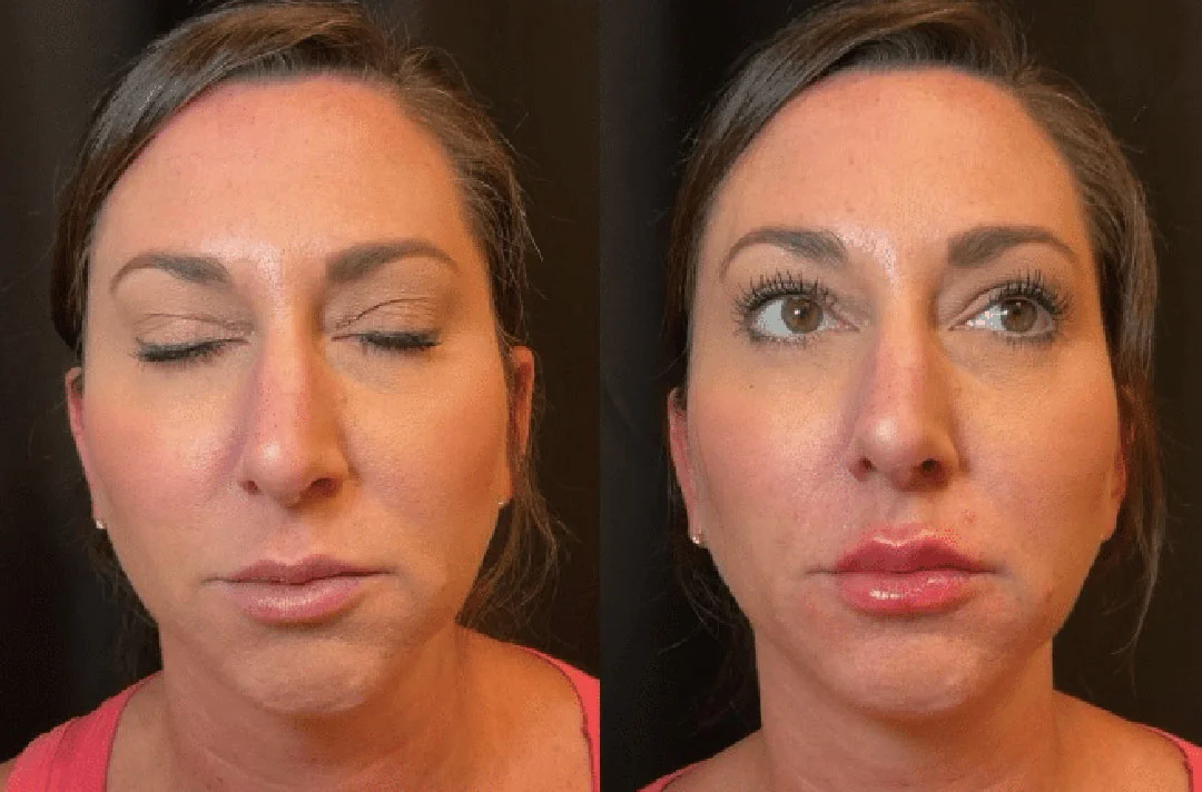 lip-filler-4