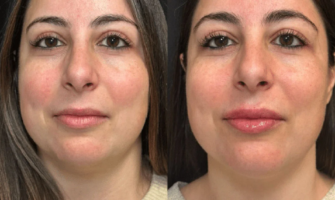lip-filler-6