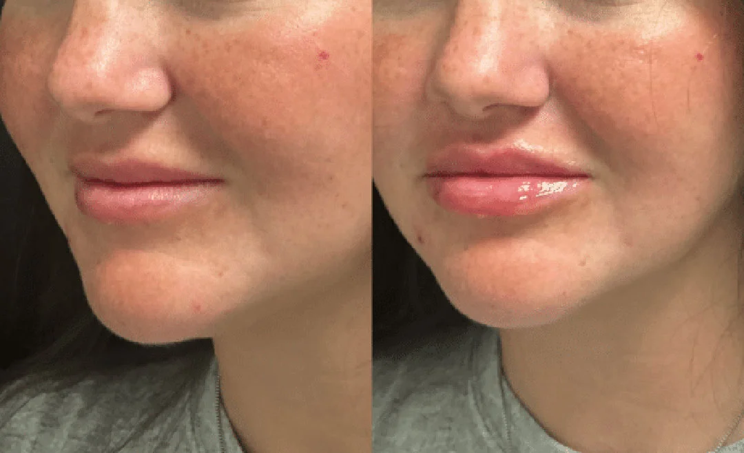 lip-filler-7