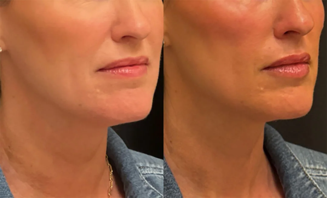 lip-filler-8