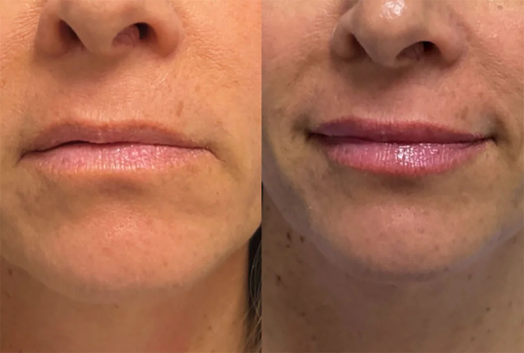 lip-filler-9
