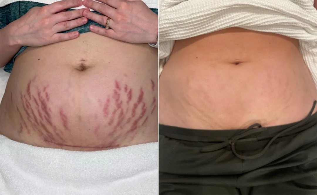 skinpen-microneedling-1
