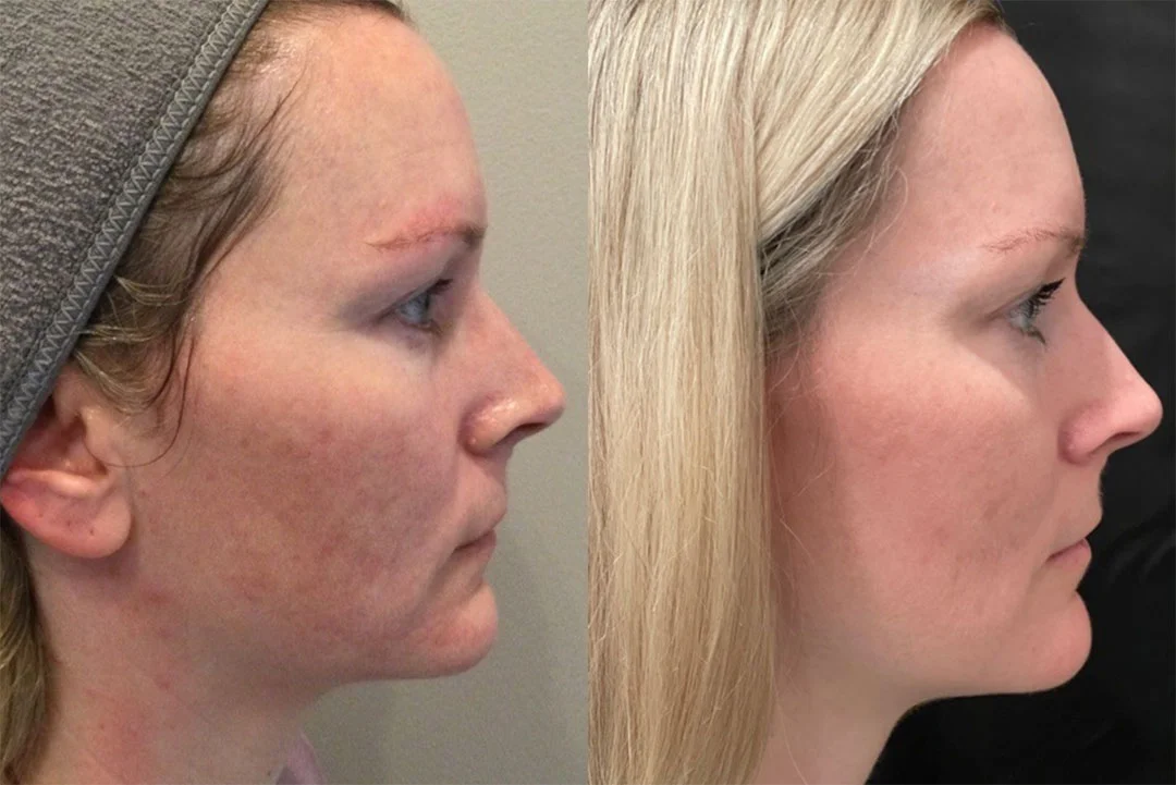 skinpen-microneedling-2