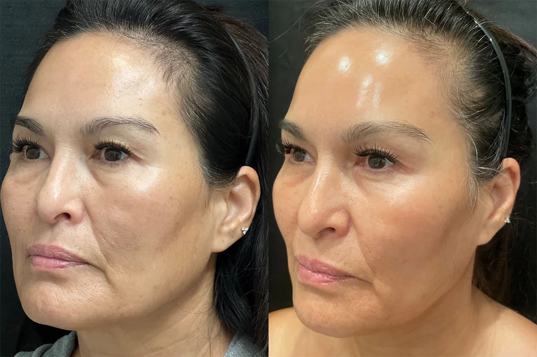 skinpen-microneedling-3