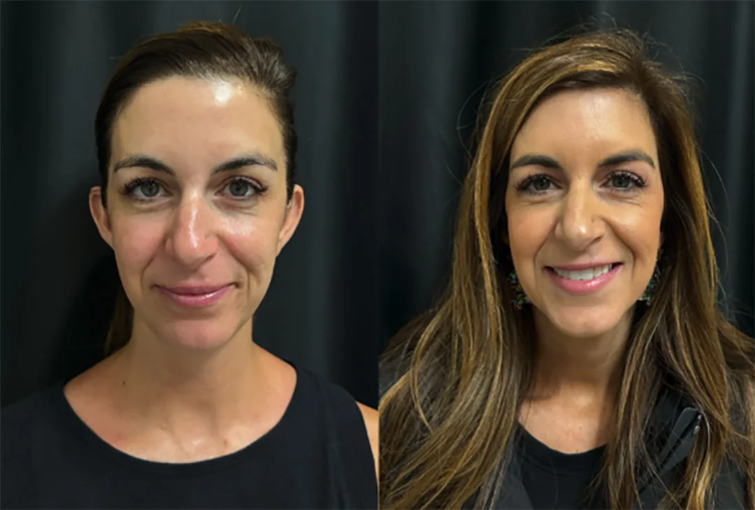 skinpen-microneedling-4