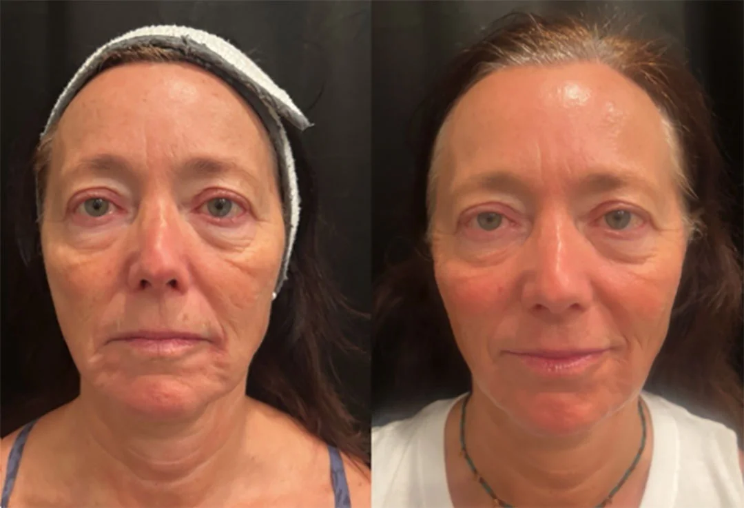 skinpen-microneedling-5
