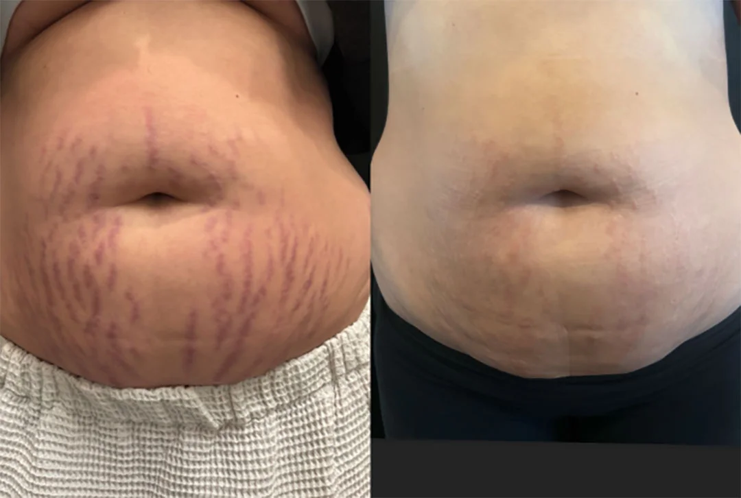 skinpen-microneedling-6
